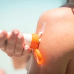 To områder, hvor folk glemmer at bruge solcreme – og det er ikke ører eller hals